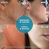 TruSkin Hyaluronic Acid Serum for Face + 7 Ultra Hydrating Ingredients