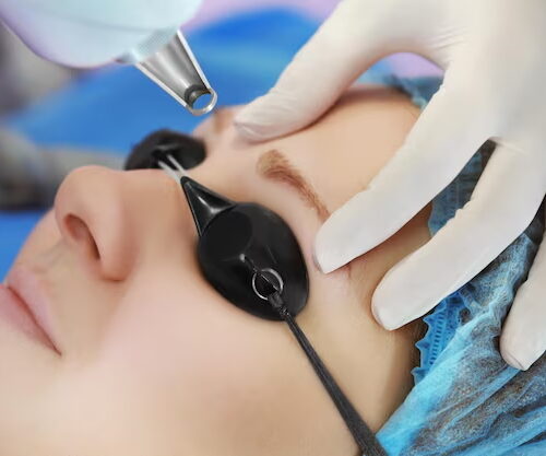 Laser removal