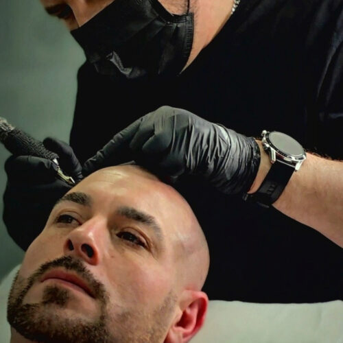 SMP Scalp Micropigmentation